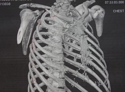 collarbone-CT.jpg