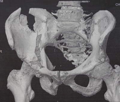 pelvis-broken.jpg